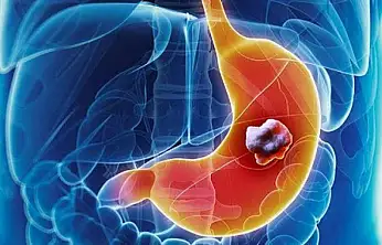 Mide kanserine yol açan riskler