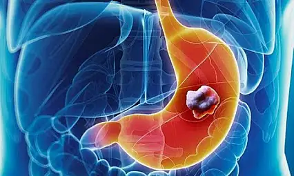 Mide kanserine yol açan riskler