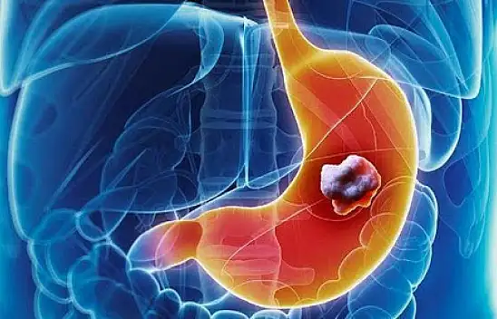 Mide kanserine yol açan riskler