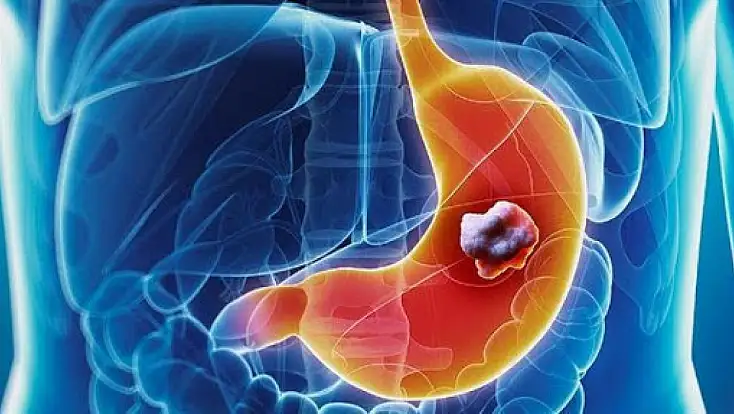 Mide kanserine yol açan riskler