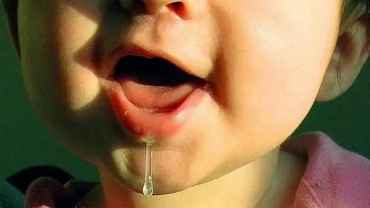 Çocuklarda salyanın nedeni geniz eti büyümesi!