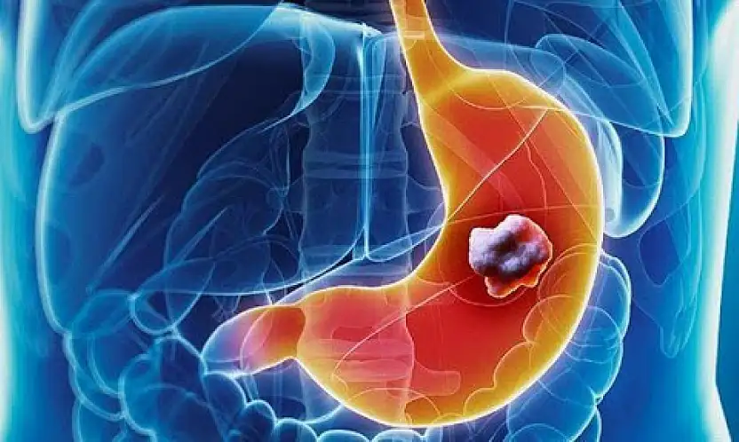 Mide kanserine yol açan riskler